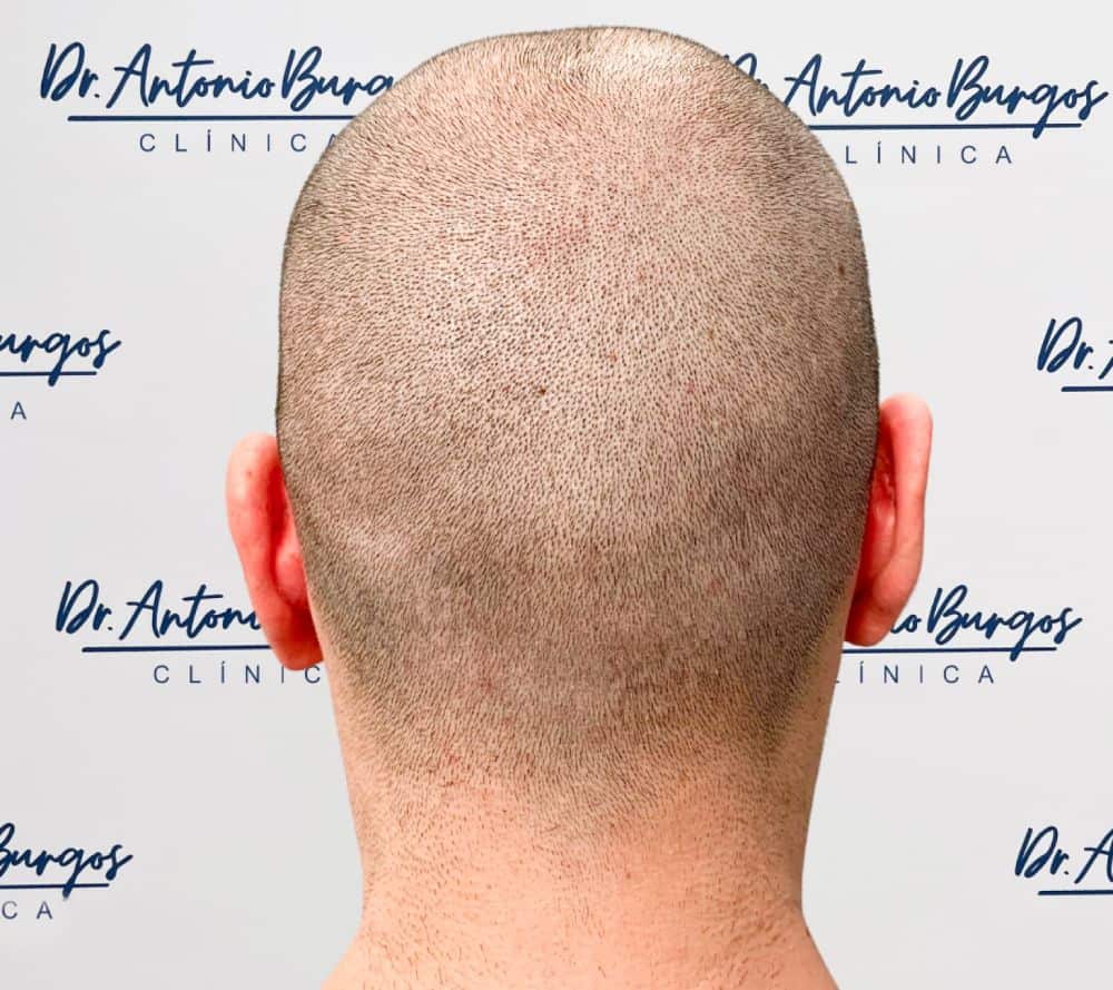 implante de cabello para hombres precio