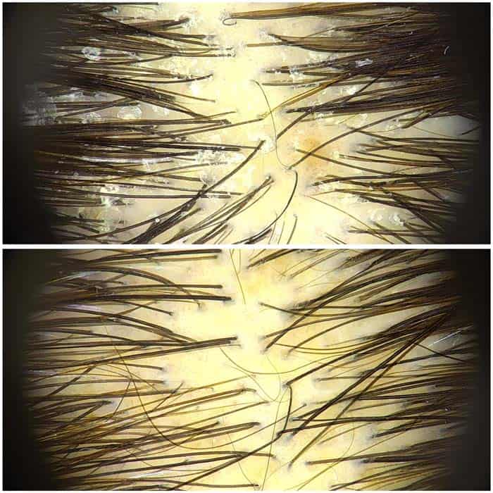 limpieza hydrafacial malaga