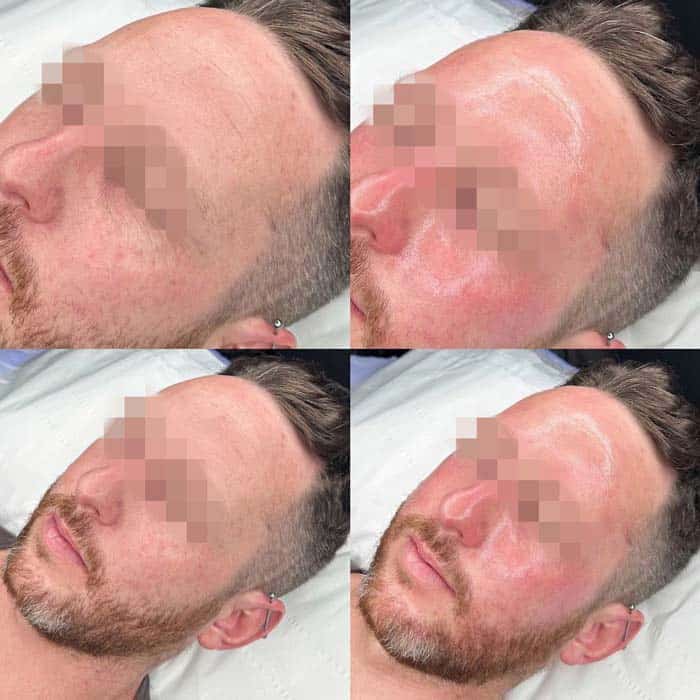 resultados hydrafacial en malaga
