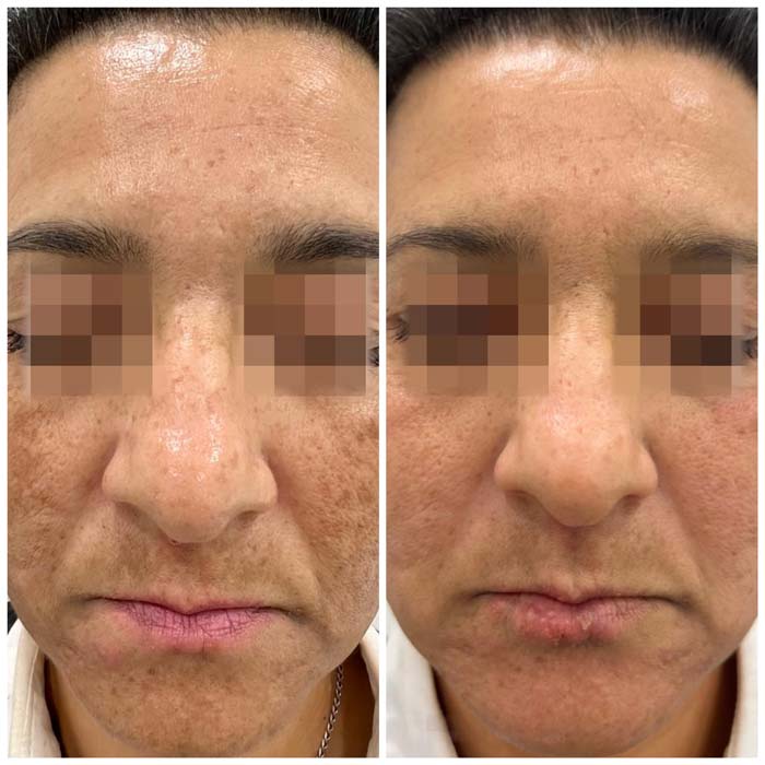 resultados manchas faciales malaga