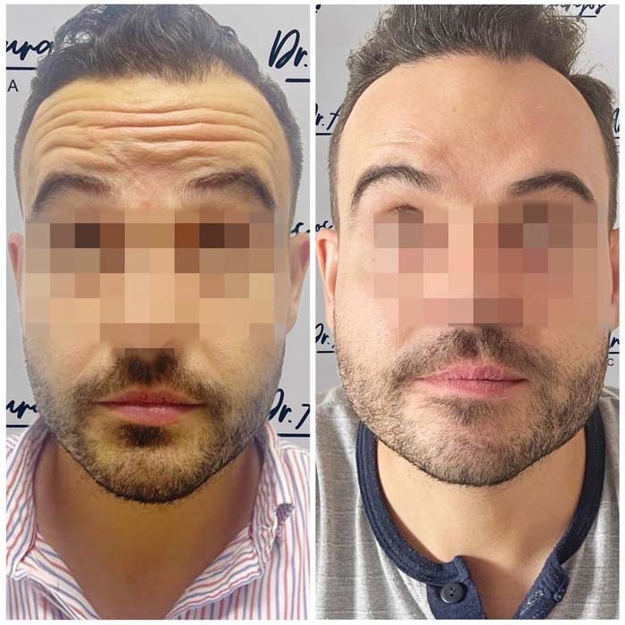 precio neuromoduladores malaga