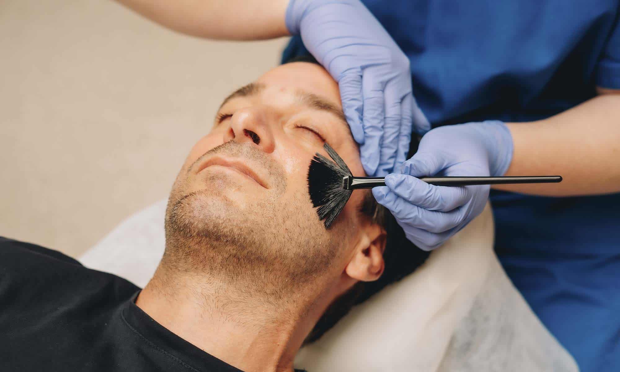 peeling quimico facial malaga