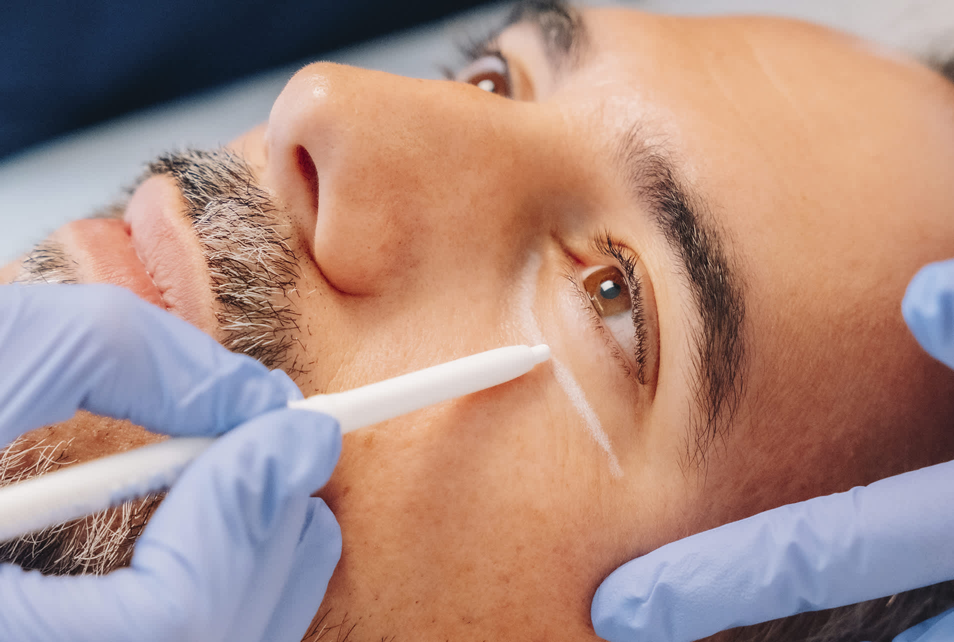 eliminar ojeras en malaga