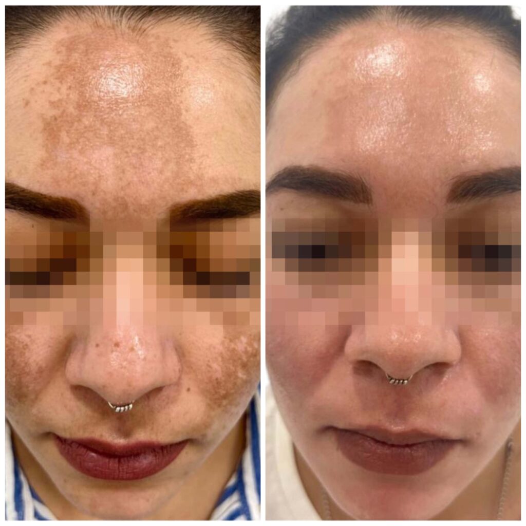 antes despues melasma malaga Clínica Burán
