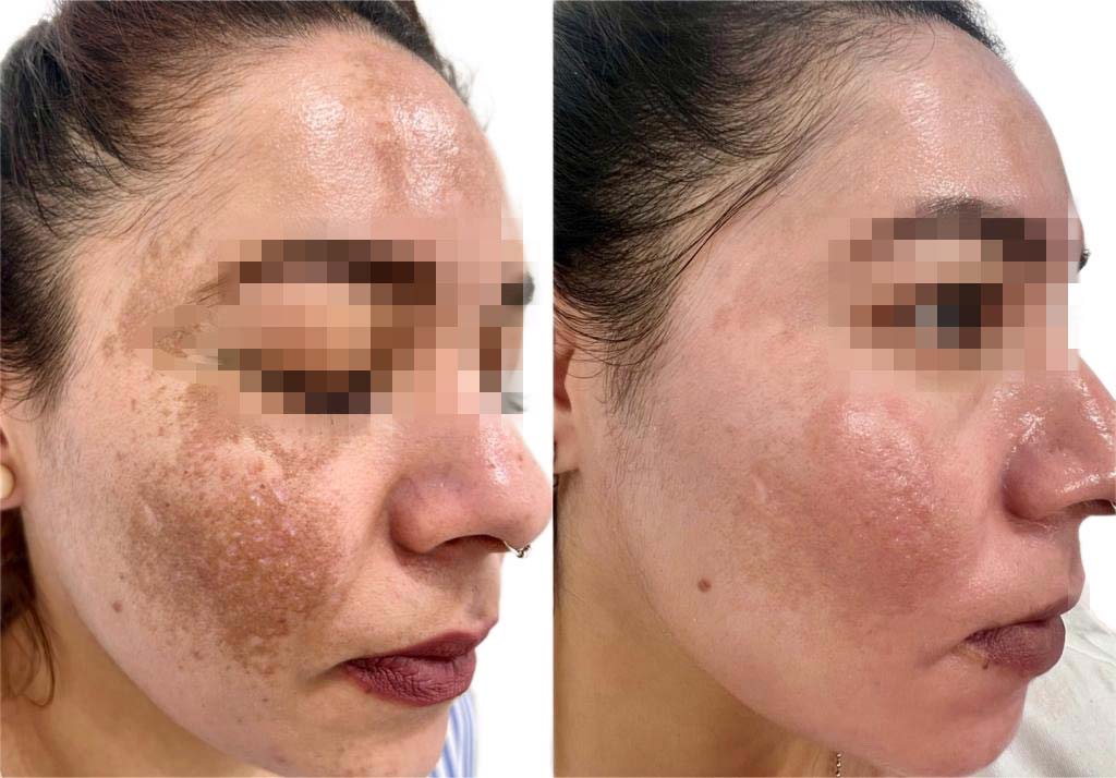 antes despues tratamiento melasma malaga Clínica Burán