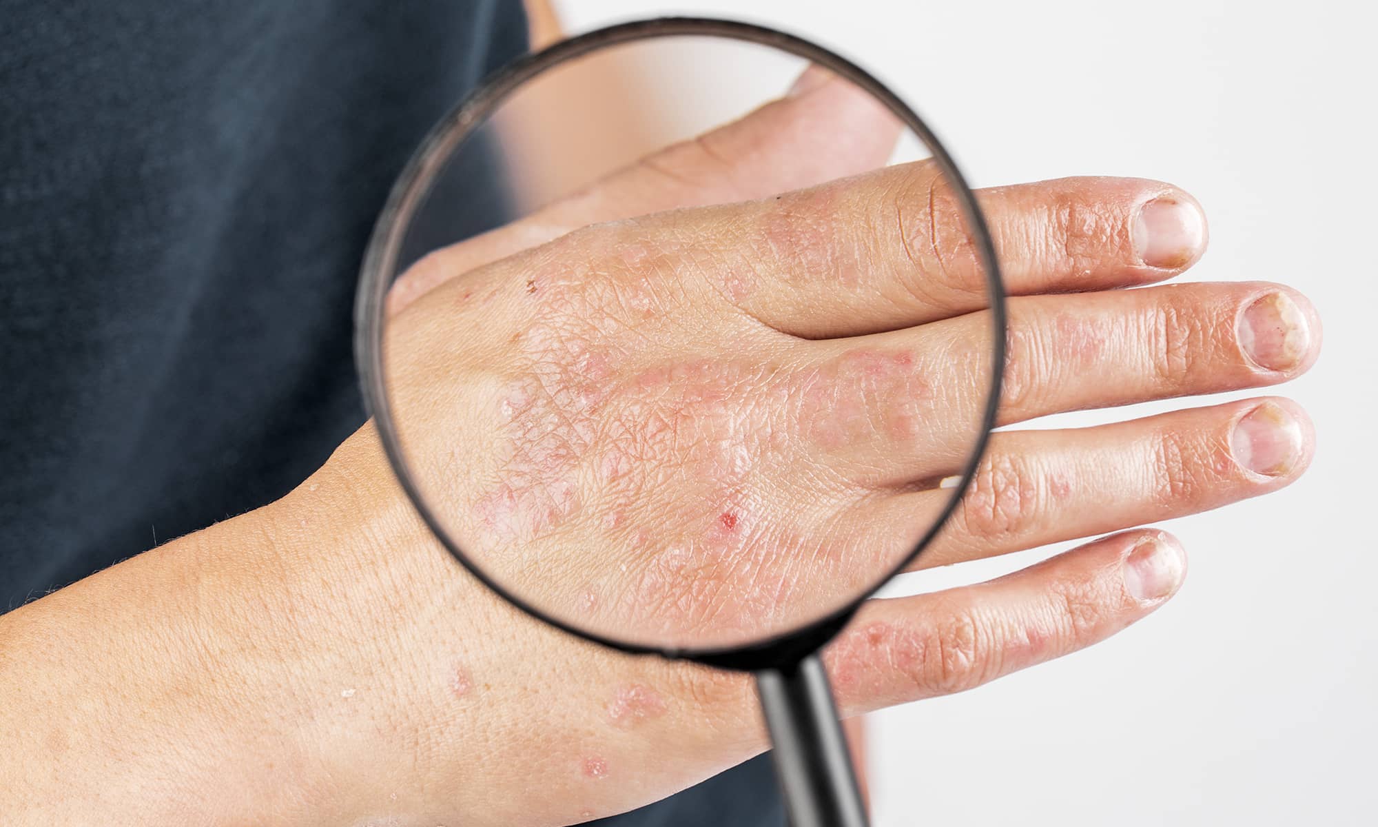 dermatitis malaga Clínica Burán