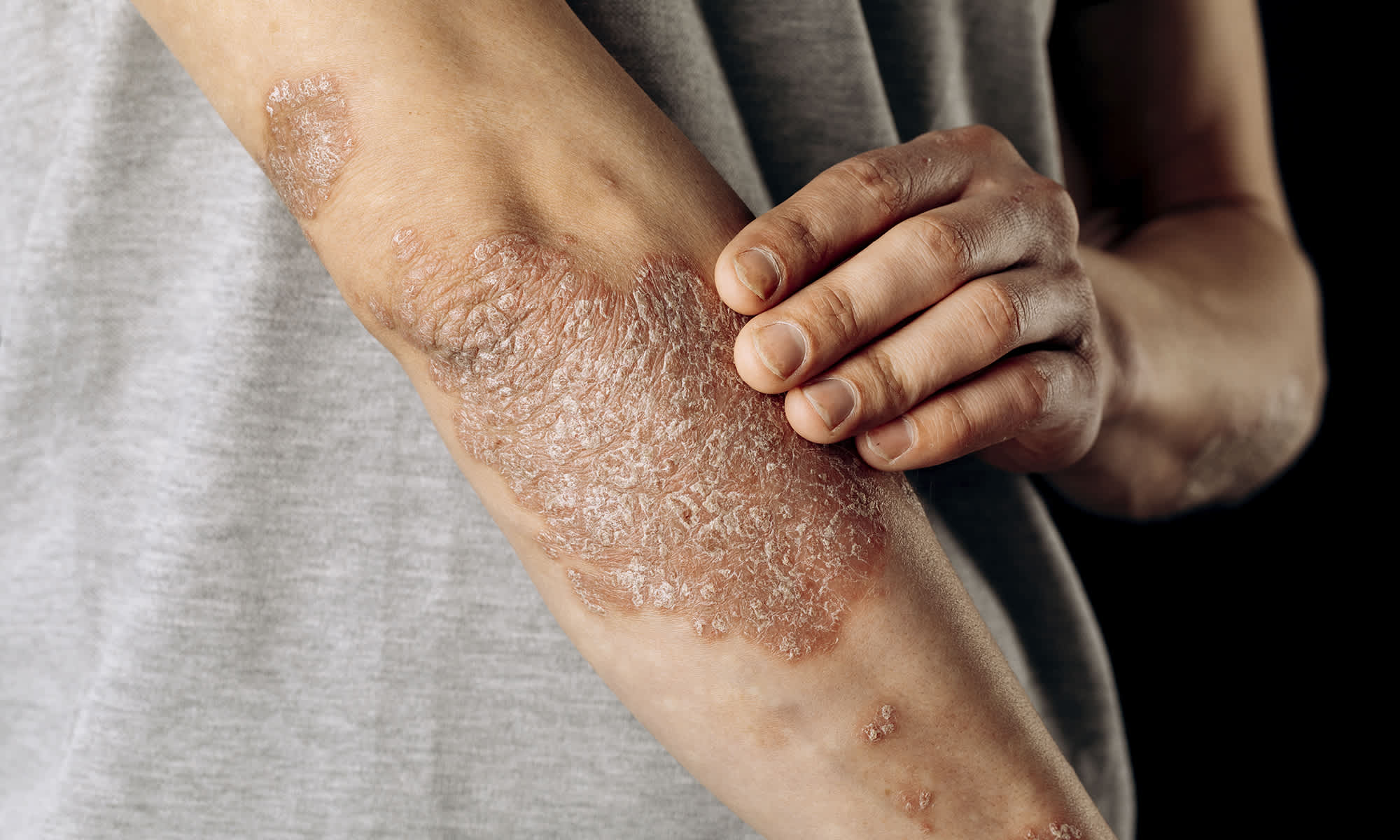 psoriasis malaga Clínica Burán