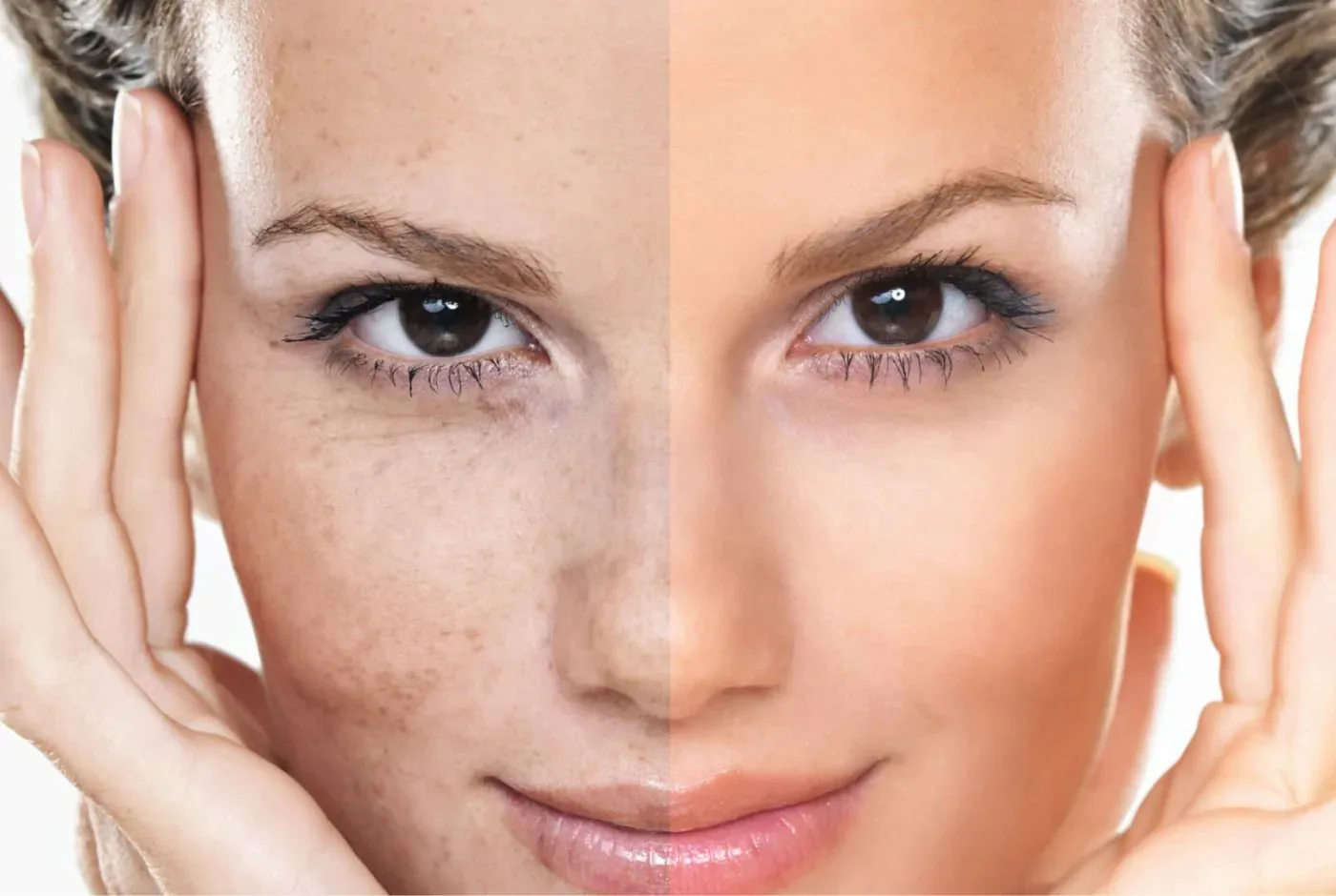 tratamiento melasma malaga Clínica Burán