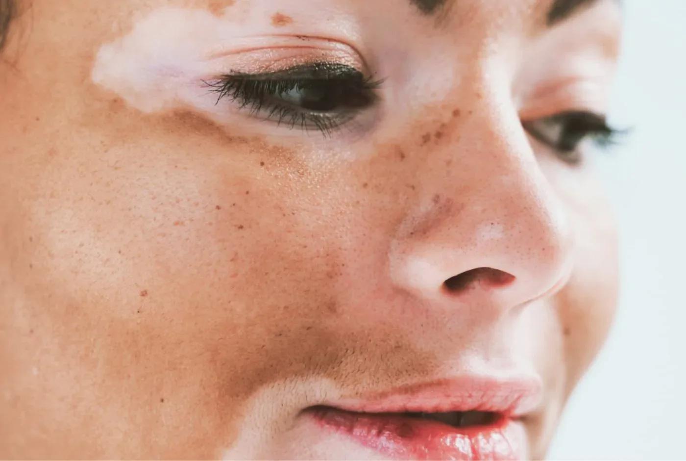 vitiligo malaga Clínica Burán