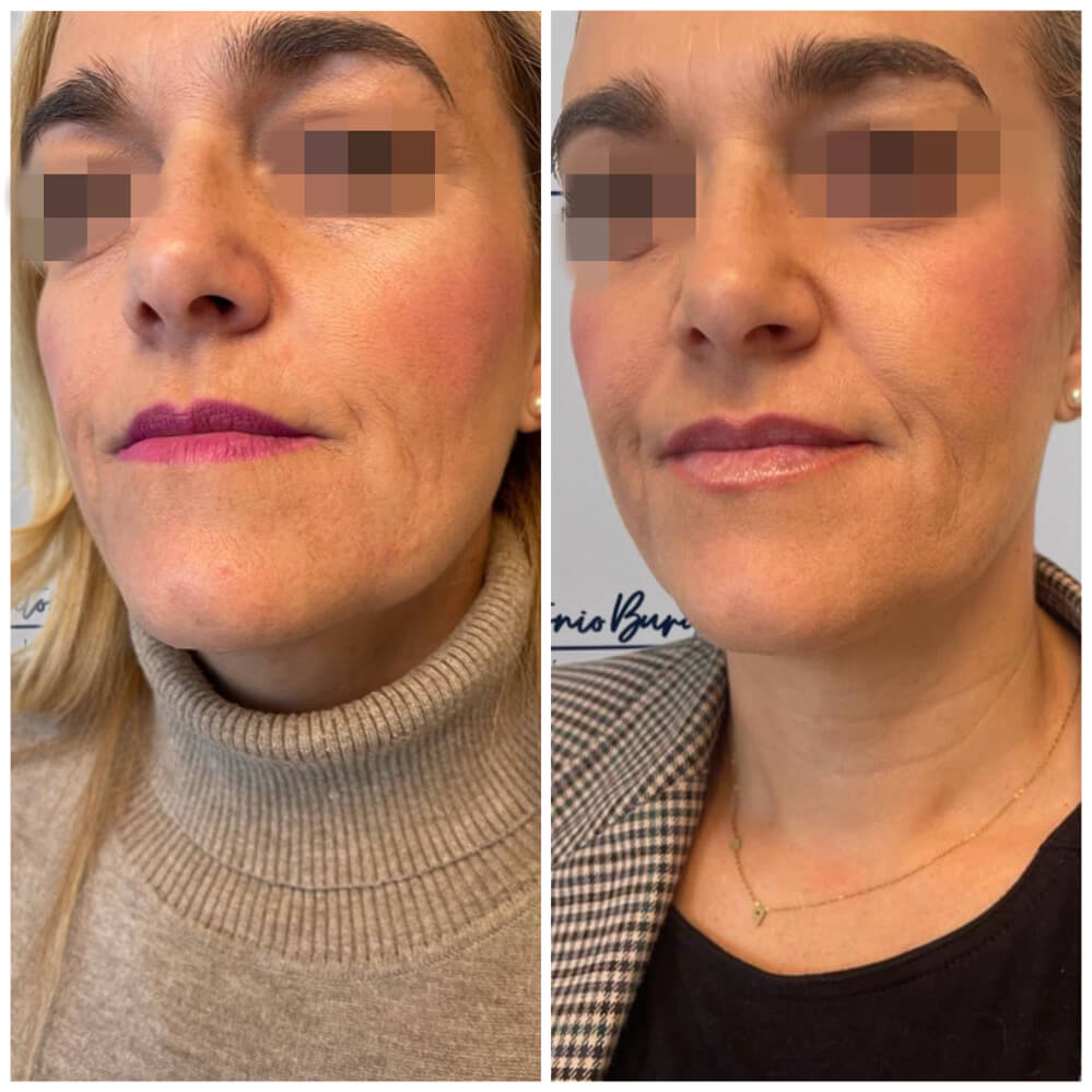 antes despues aumento labios clinica antonio burgos 1 Clínica Burán