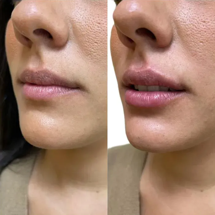 antes-despues-de-rellenos-faciales-malaga-2
