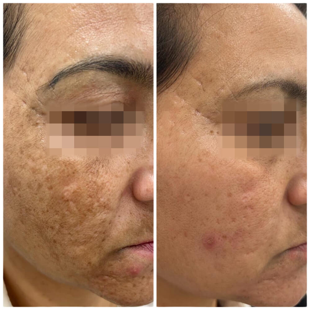 antes despues tratamiento melasma 1 Clínica Burán