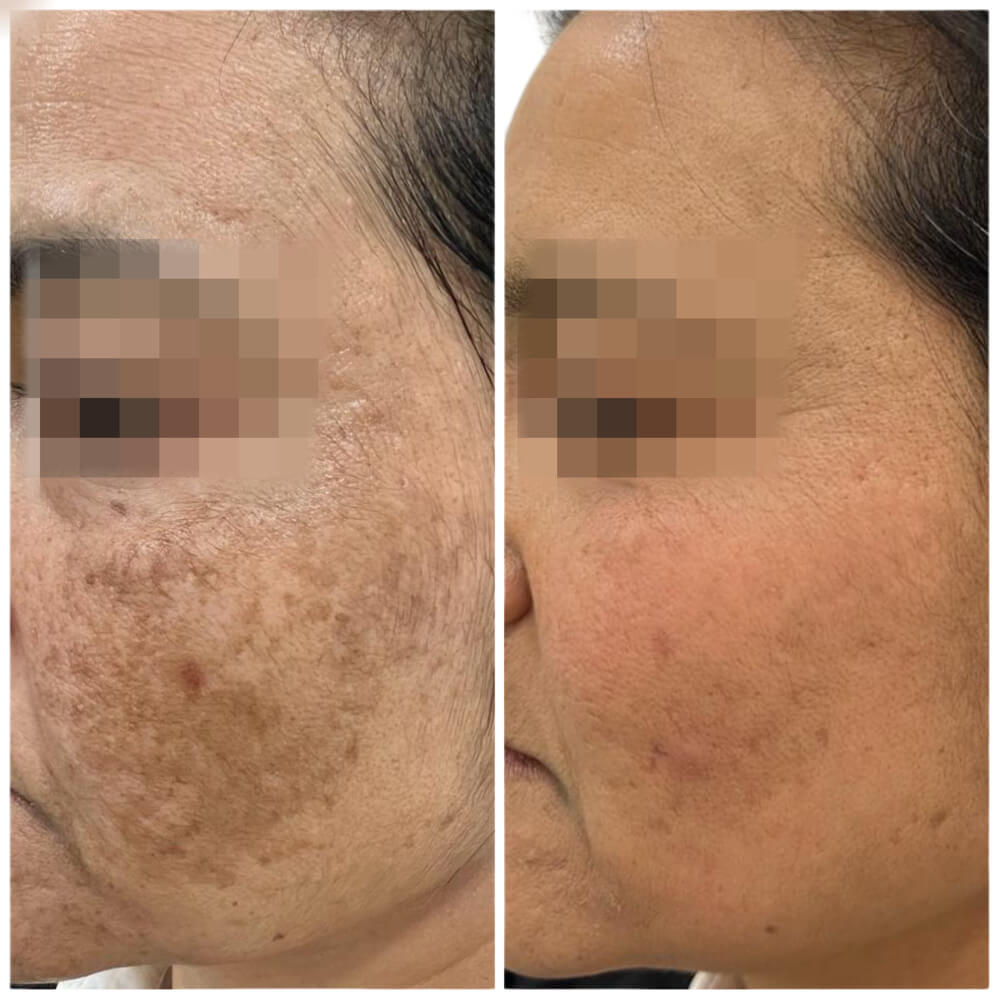 antes despues tratamiento melasma 3 Clínica Burán