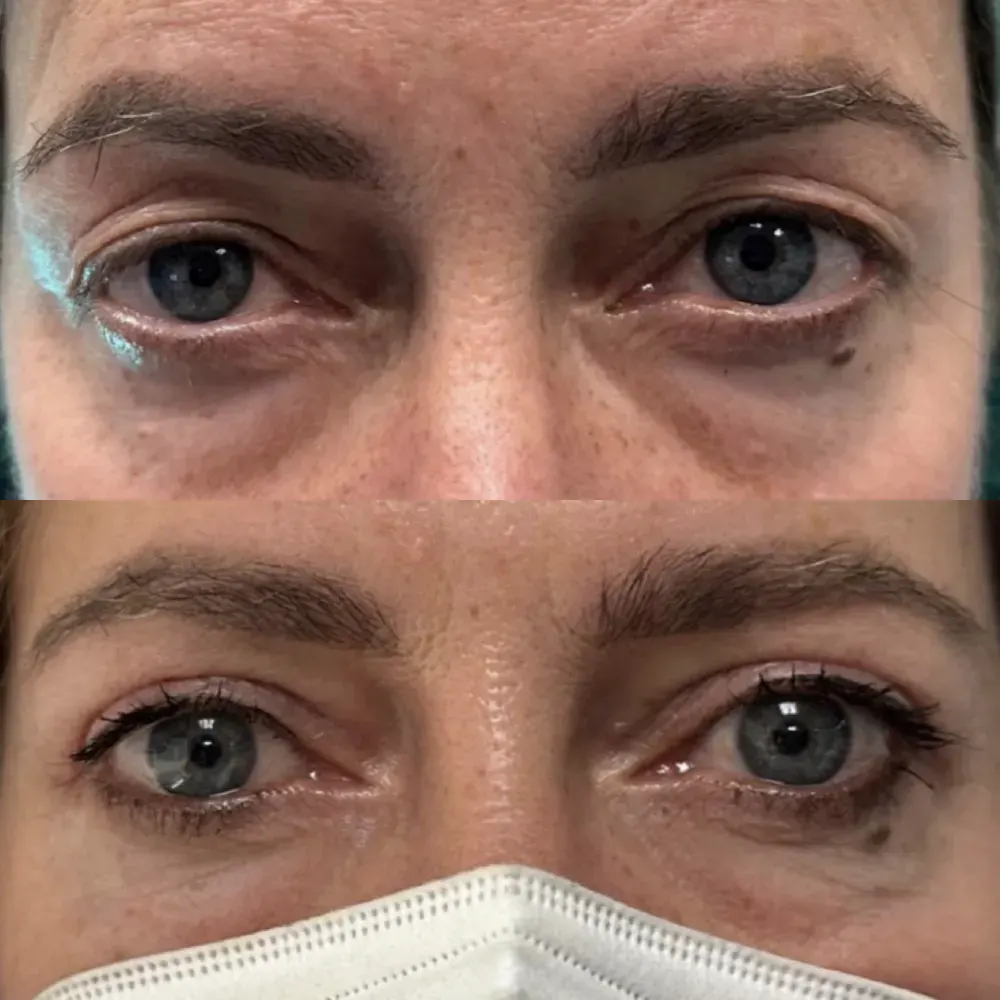 blefaroplastia parpado superior mujer Clínica Burán