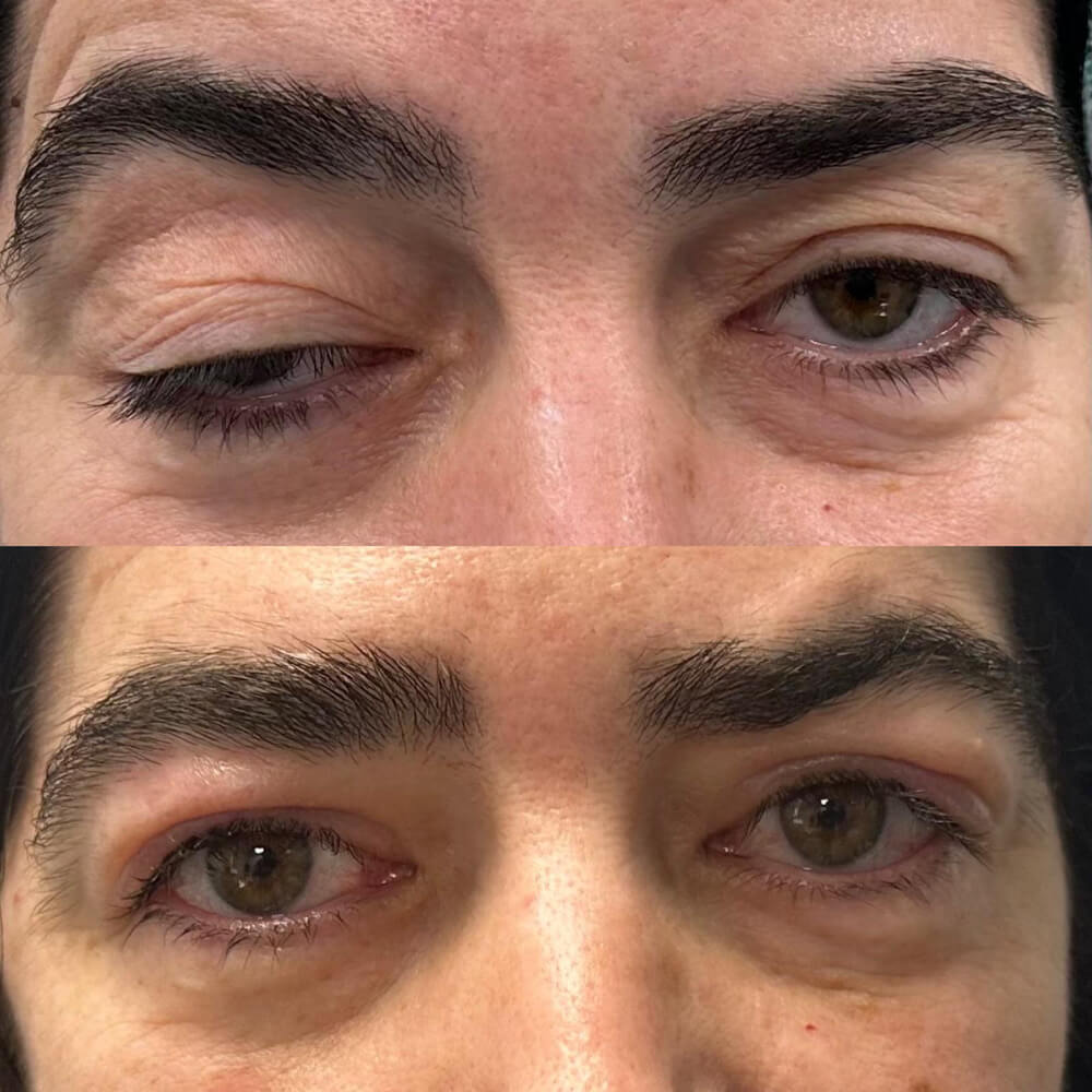 resultados blefaroplastia malaga clinica antonio burgos 3 Clínica Burán