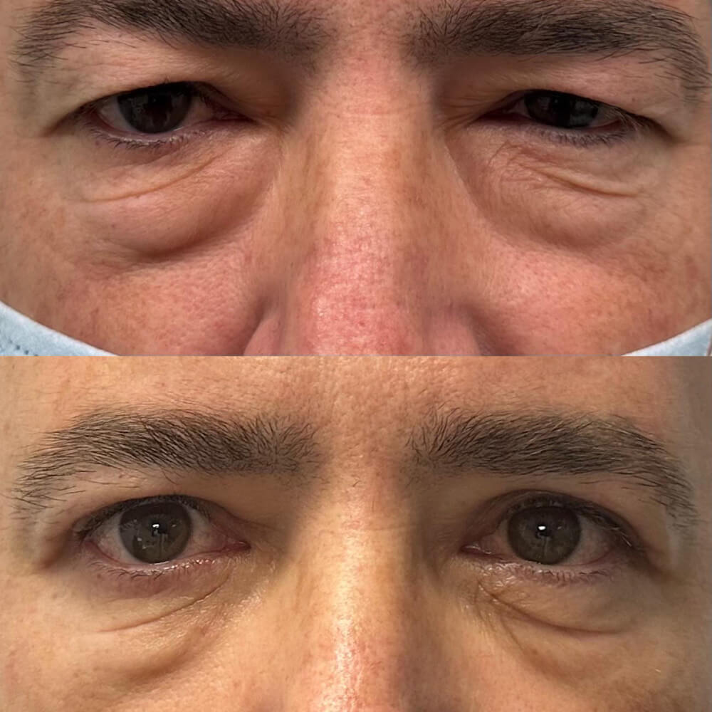 resultados blefaroplastia malaga clinica antonio burgos 5 Clínica Burán