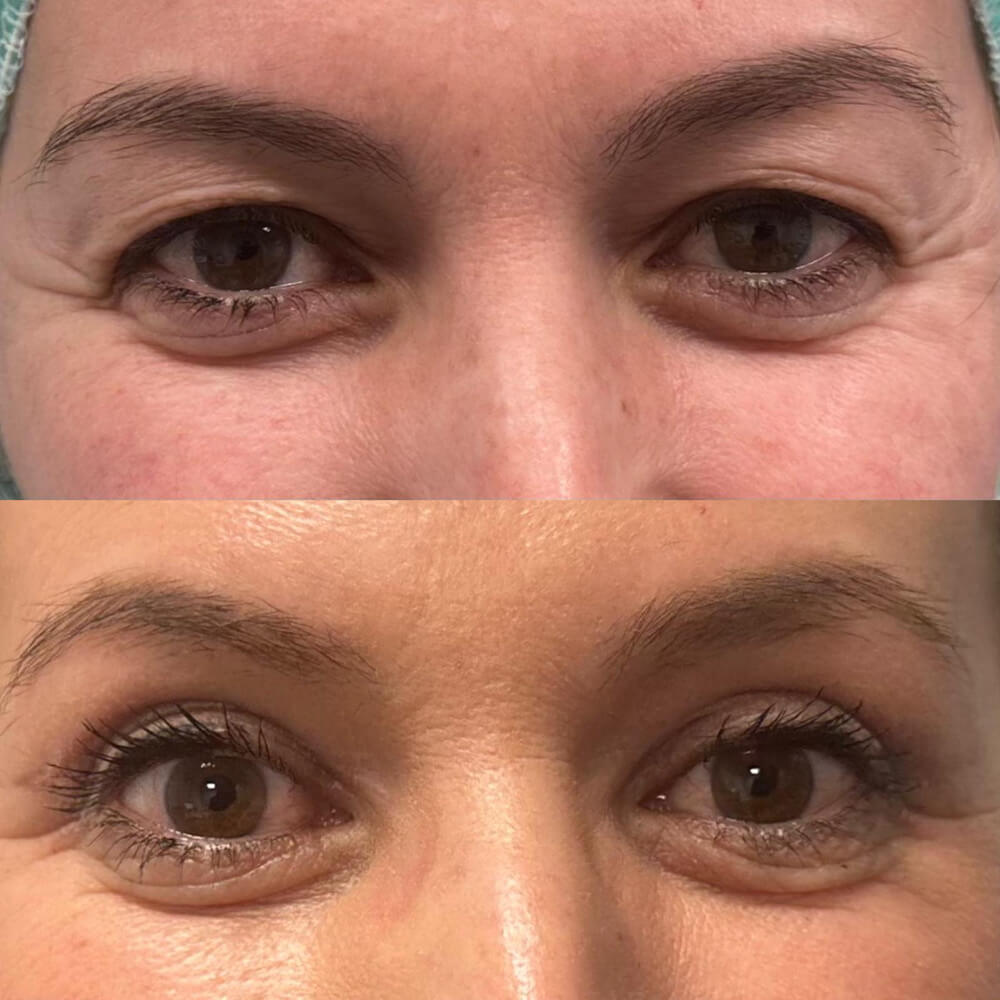 resultados blefaroplastia malaga clinica antonio burgos 6 Clínica Burán