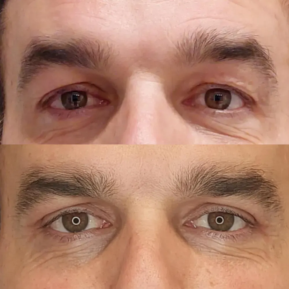 resultados blefaroplastia malaga clinica antonio burgos 82 Clínica Burán