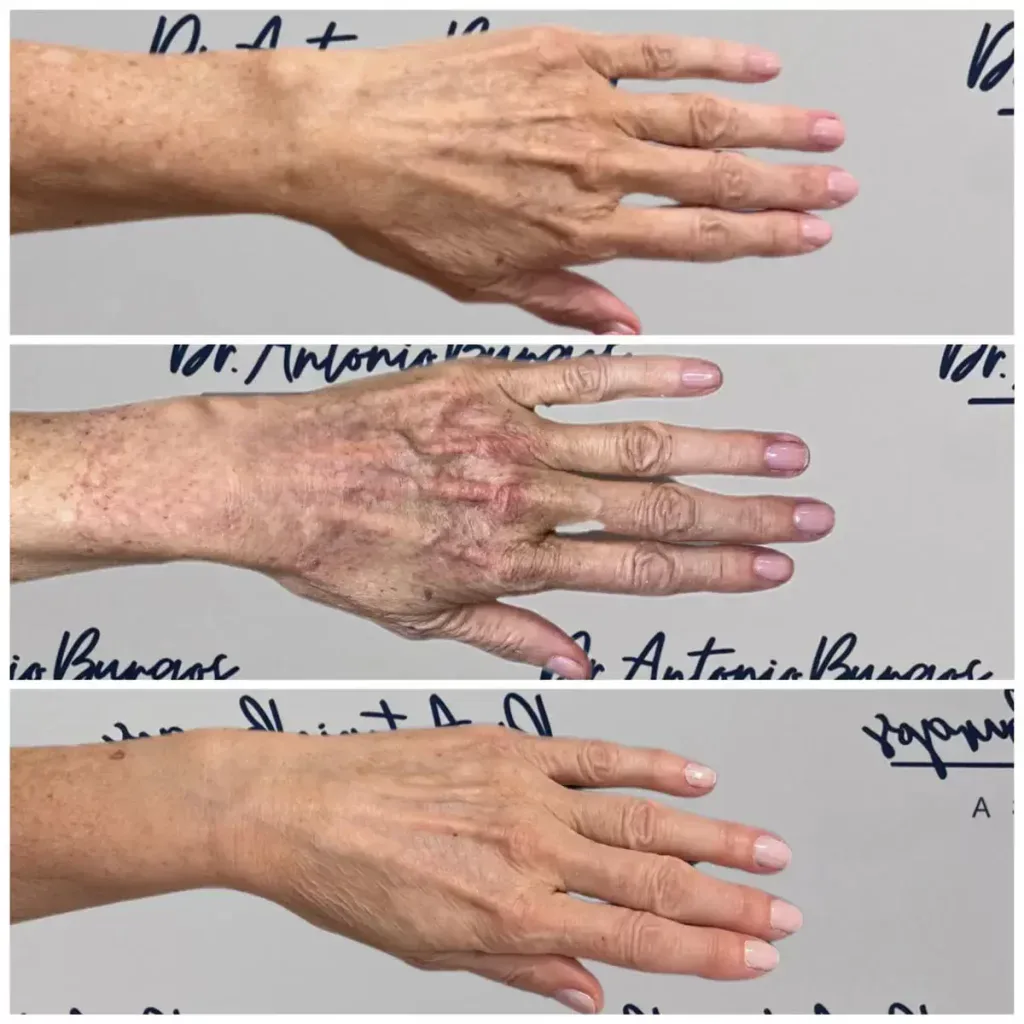 IPL malaga luz pulsada intensa antes y despues manos Clínica Burán