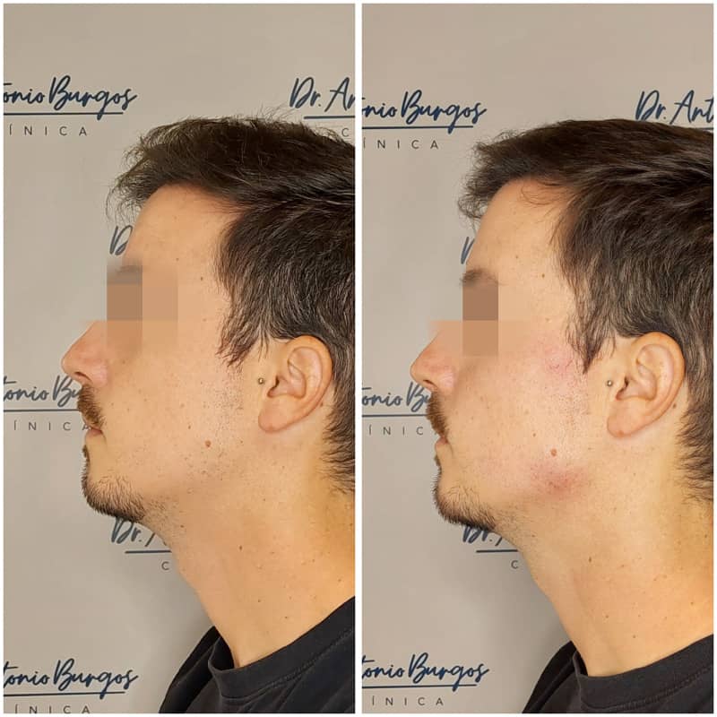 antes despues marcacion mandibular 2.JPEG Clínica Burán