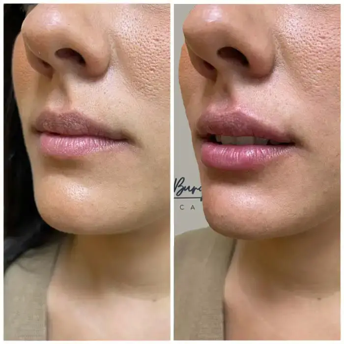 resultados clinica aumento de labios malaga Dr. Antonio Burgos