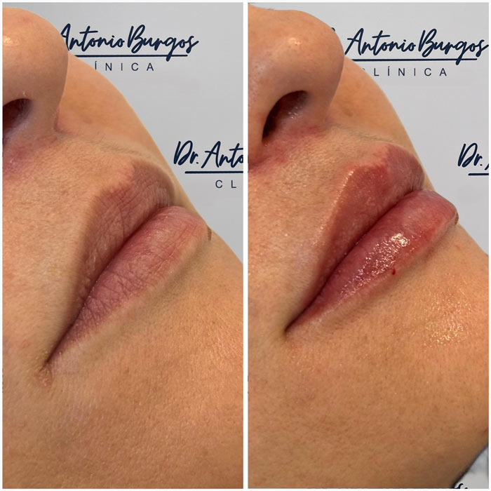 aumento labios resultados antes despues clinica antonio burgos