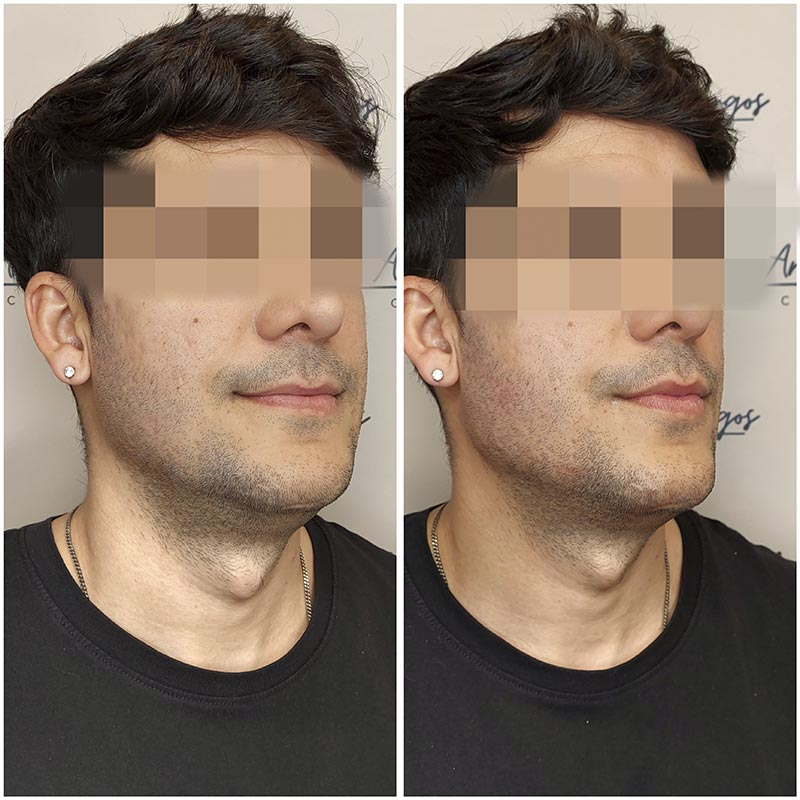antes despues marcacion mandibular Clínica Burán