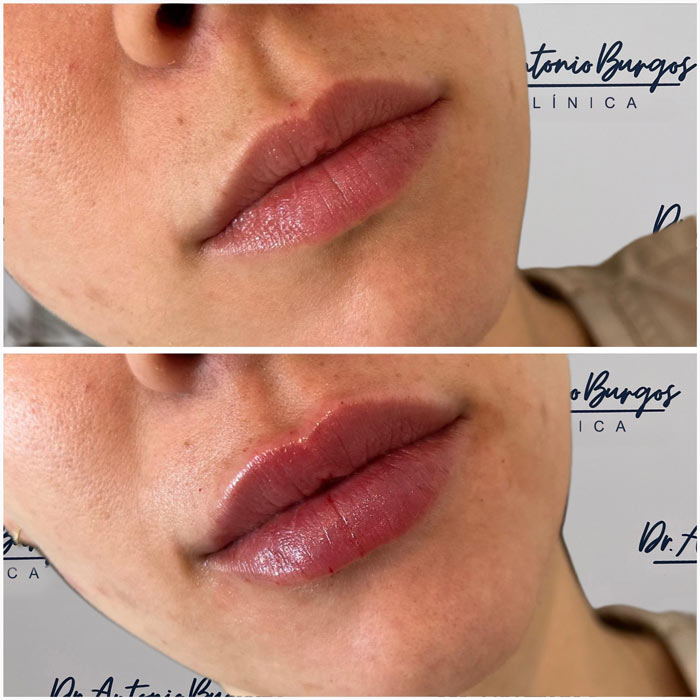resultados antes despues aumento labios