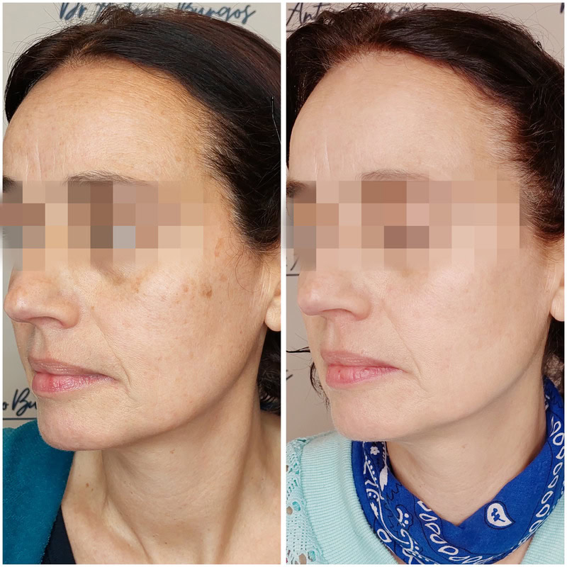 resultados manchas faciales