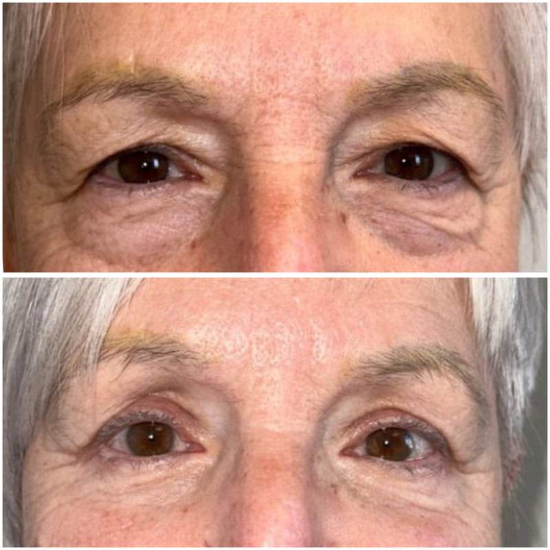 resultados blefaroplastia completa malaga