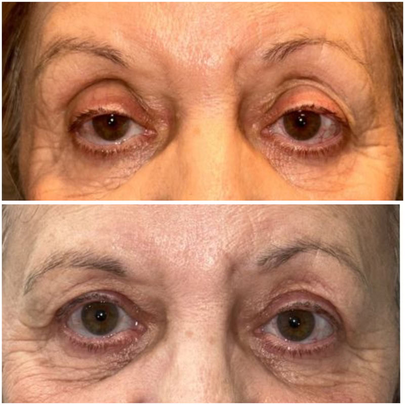 resultados blefaroplastia superior malaga