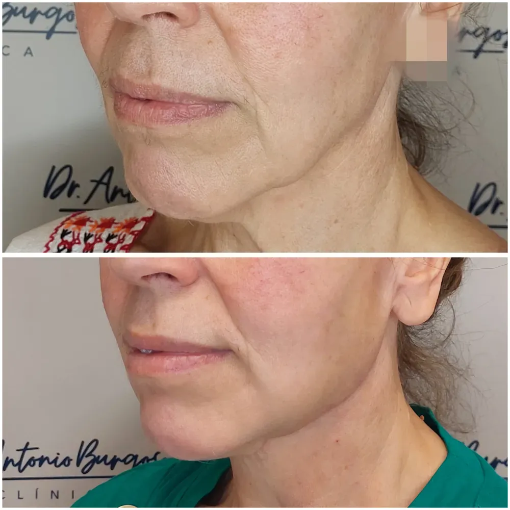 antes y despues endolift en malaga