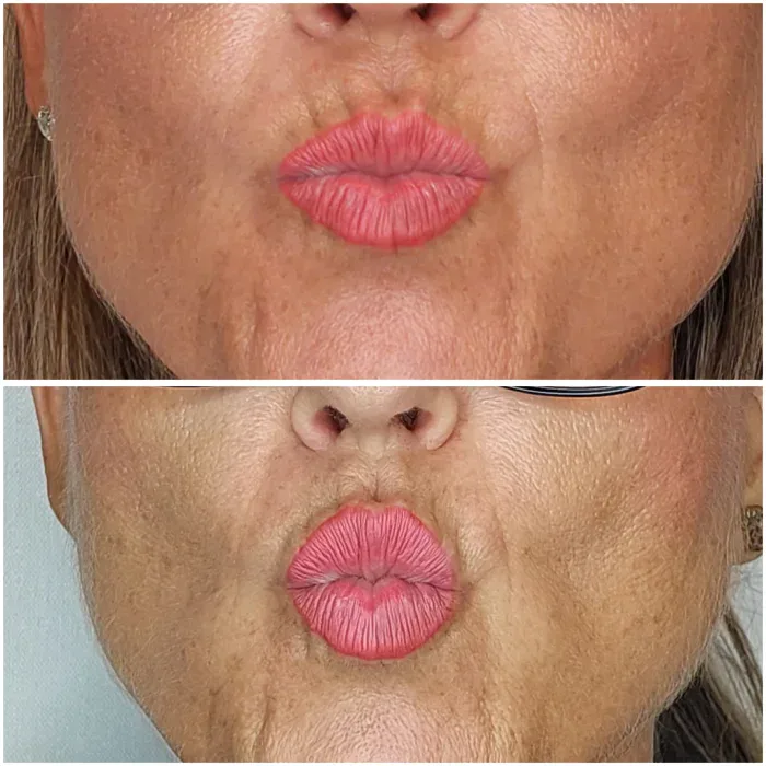 resultados aumento de labios en hombre