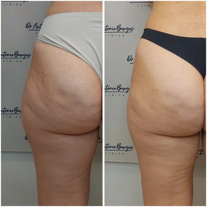 endolift celulitis antes despues malaga 25 11 2 Clínica Burán