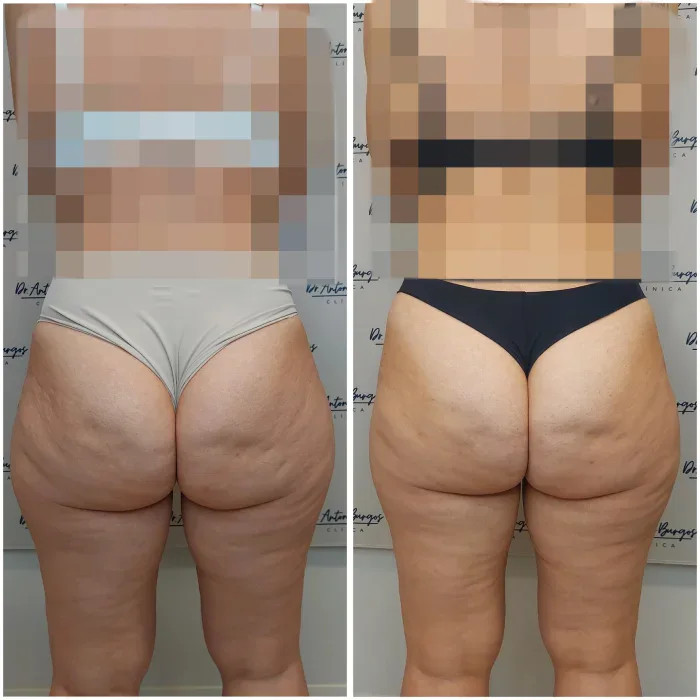 endolift celulitis antes despues malaga 25 11 Clínica Burán