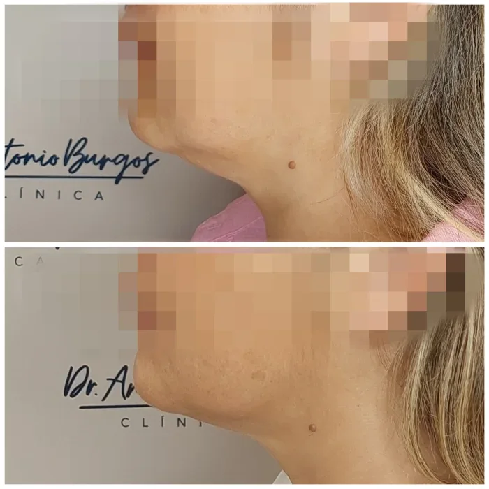 endolift papada antes despues malaga 25 11 Clínica Burán