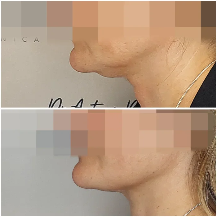 endolift tercio inferior antes despues malaga 25 11 Clínica Burán