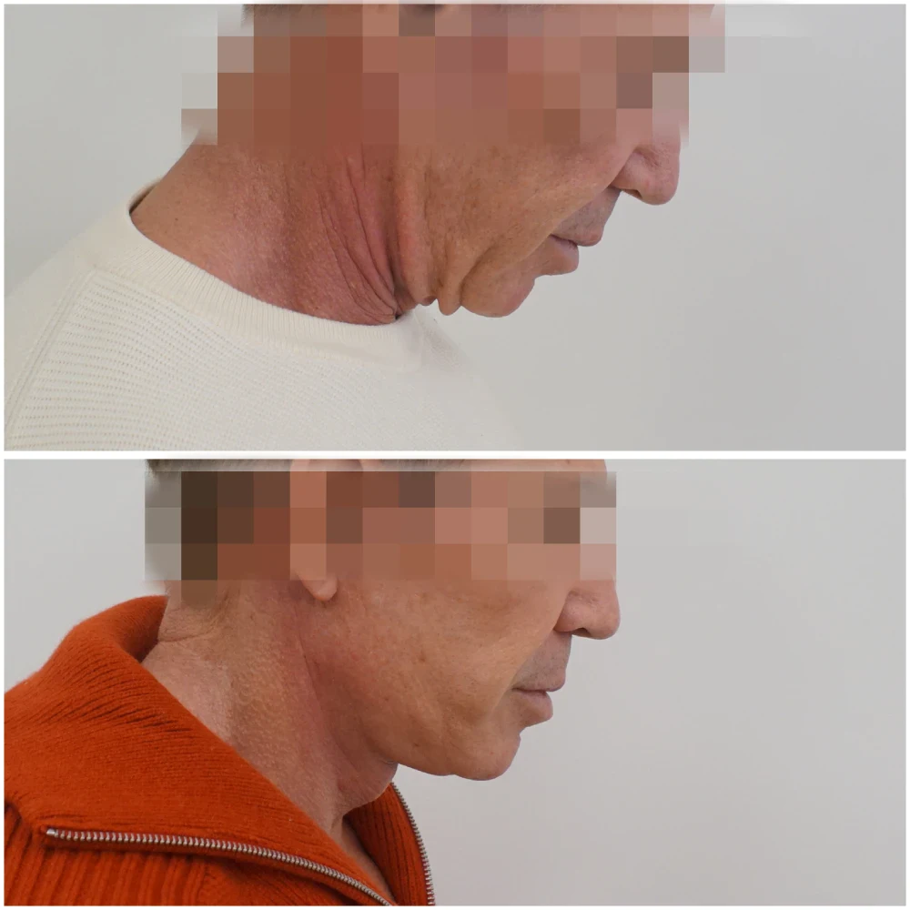 lifting facial precio malaga