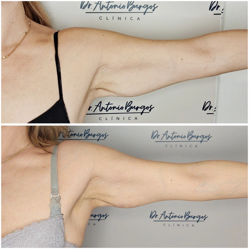 resultados endolift en brazos