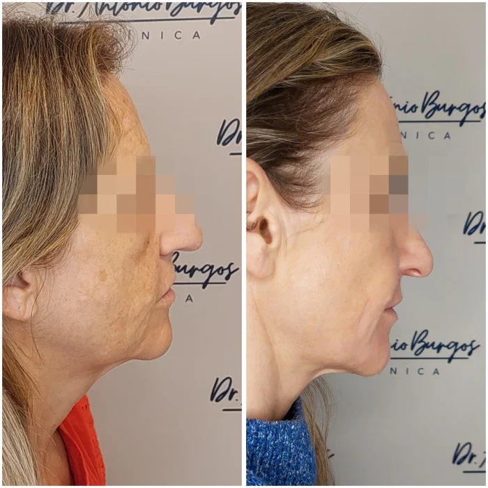ipl tratamiento rellenos dermicos dr antonio burgos 2 Clínica Burán