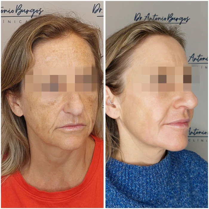 tratamiento ipl