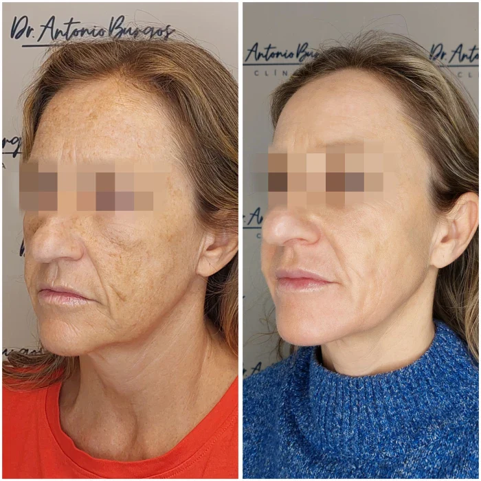 ipl tratamiento rellenos dermicos dr antonio burgos Clínica Burán
