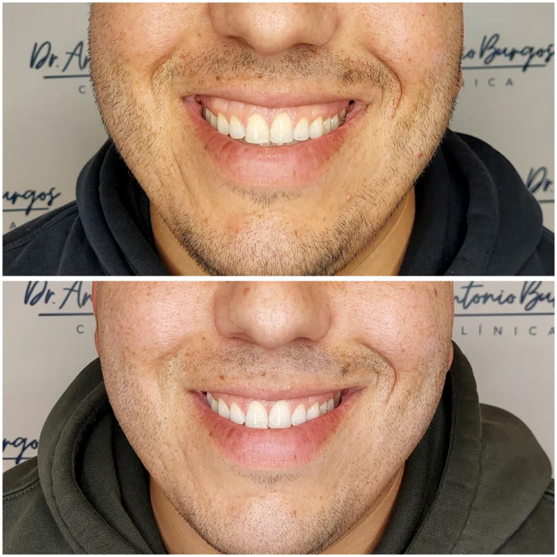 sonrisa gingival acido hialuronico malaga Clínica Burán