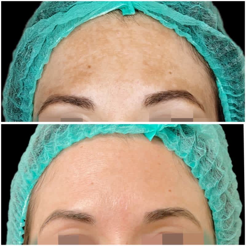 tratamiento melasma malaga antes despues 4.jpeg Clínica Burán