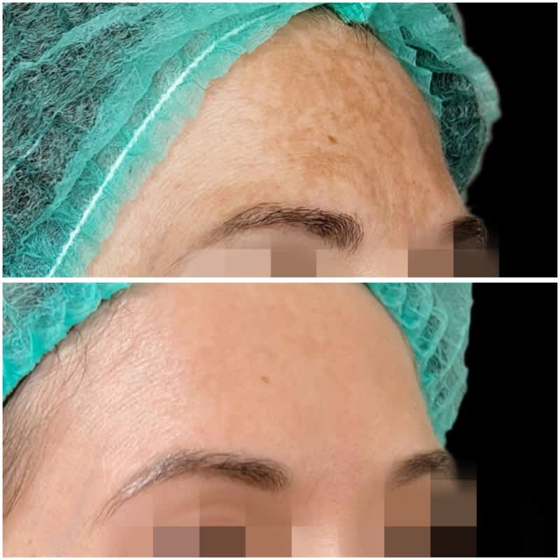 tratamiento melasma malaga antes despues 6.jpeg Clínica Burán