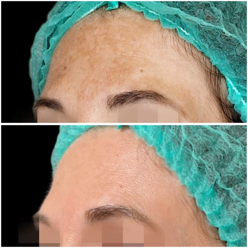 tratamiento melasma malaga antes despues 8.jpeg Clínica Burán