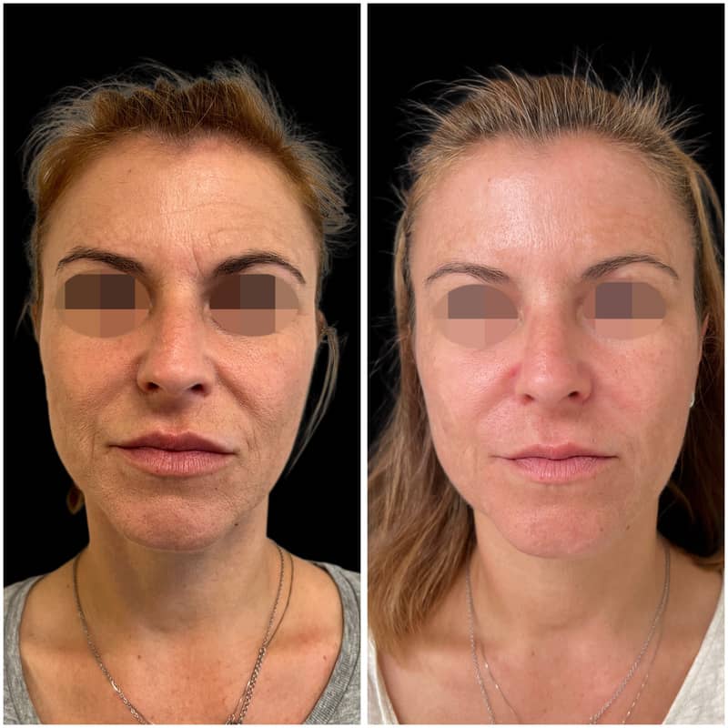 Resultado de rejuvenecimiento facial mediante tratamiento con neuromoduladores