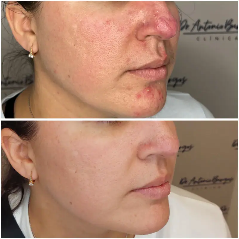 Rosácea facial antes y después de tratamiento en Málaga