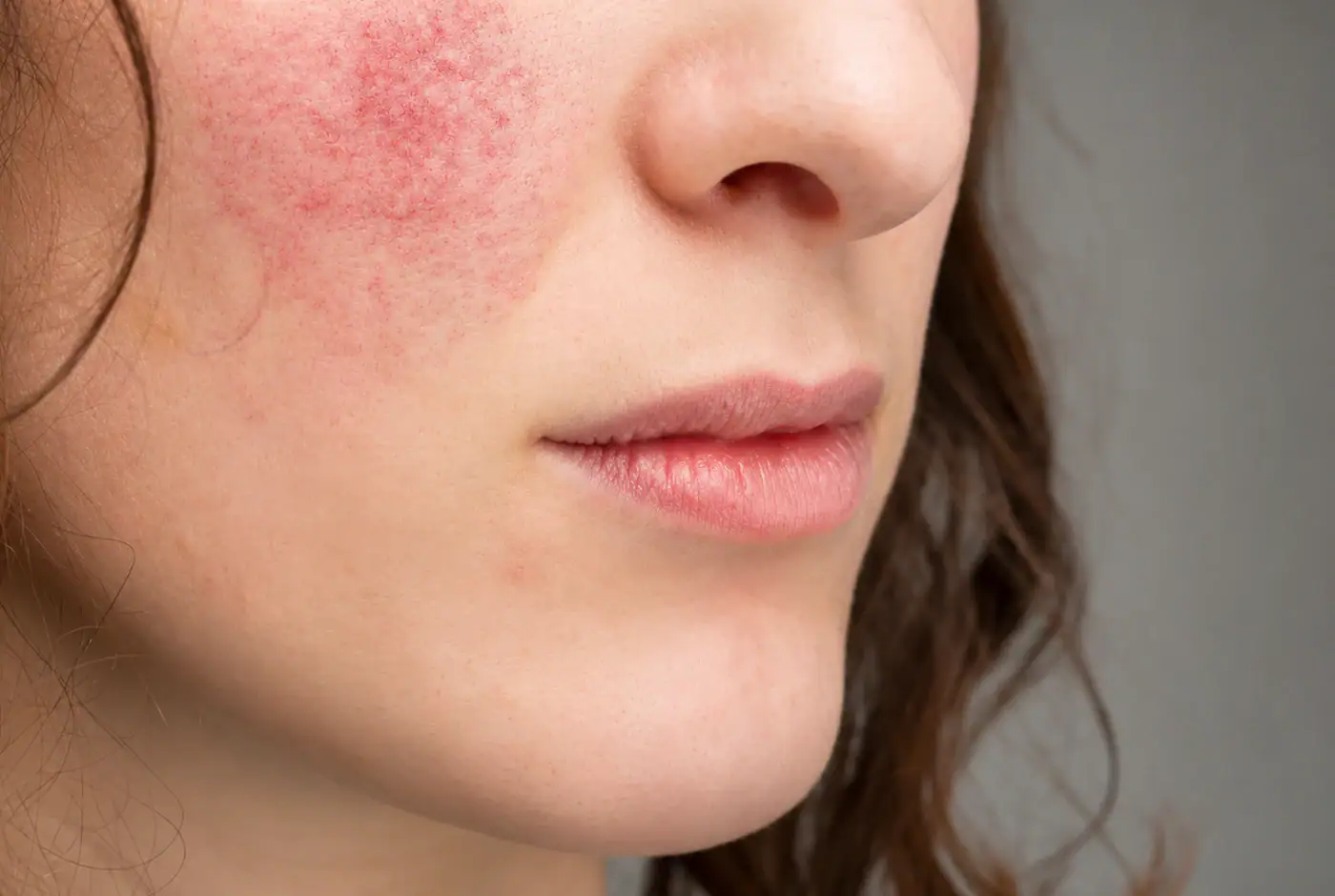 tratamiento de rosácea facial en Málaga
